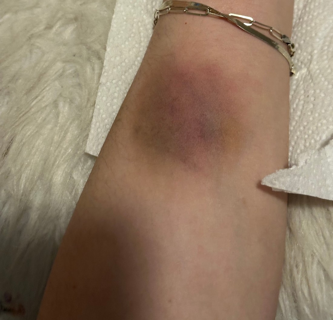 Painted contusion effect showing realistic multi-day bruise colouring